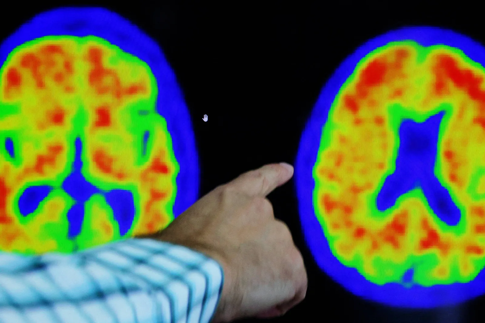 Exames de sangue para Alzheimer chegam à rede particular por até R$ 5.000